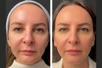 Mesotherapy Treatment in Dubai: The Celebrity Secret to Flawless Skin